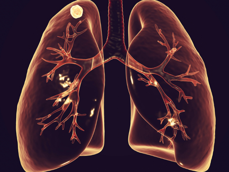 bronchiolitis